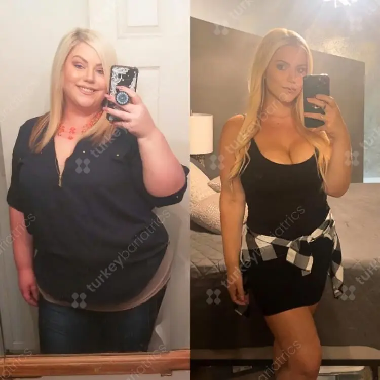 Gastric Sleeve Before and After Photo Turkey