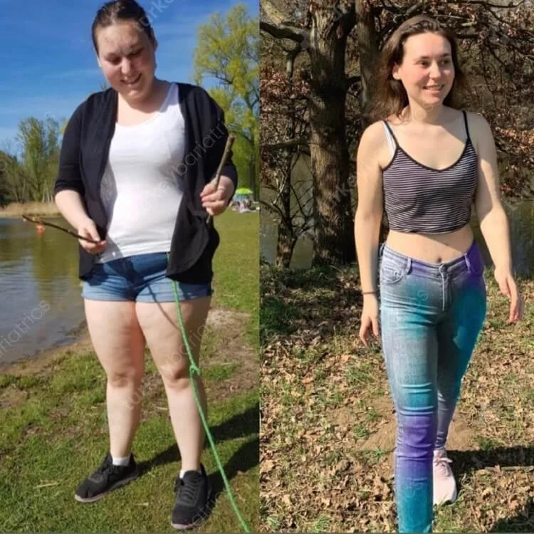 Gastric Sleeve Before and After Photo Turkey