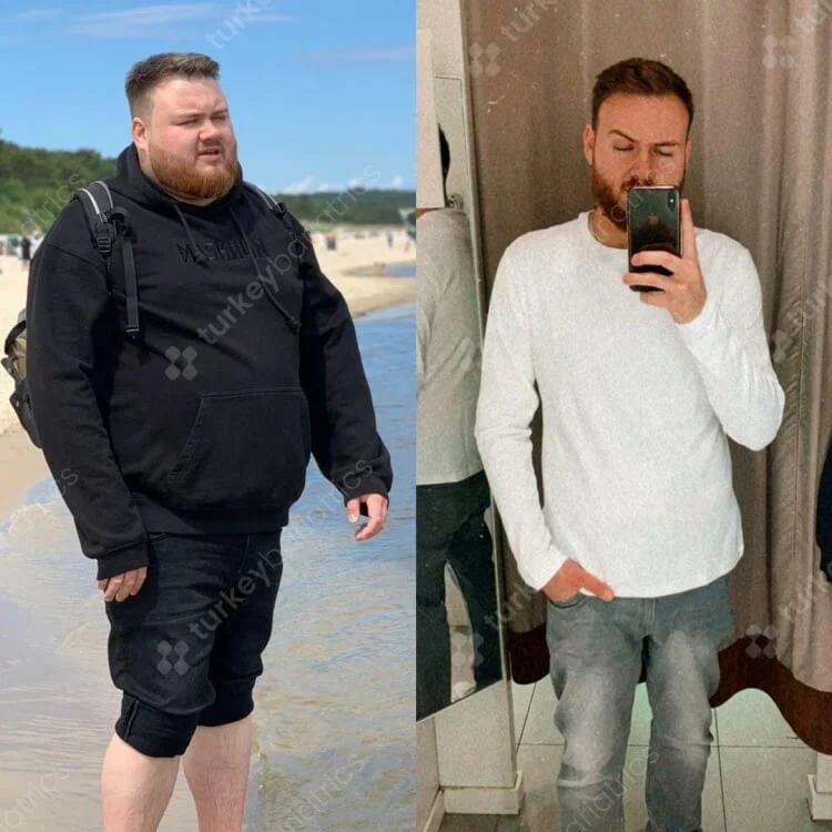 Gastric Sleeve Before and After Photo Turkey