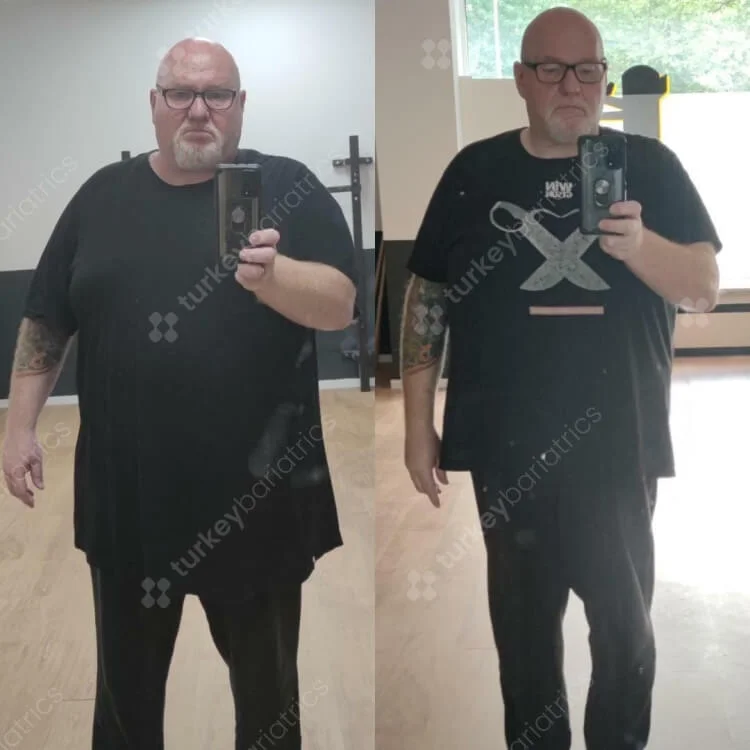 Gastric Sleeve Before and After Photo Turkey